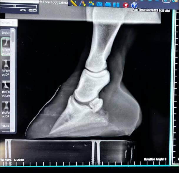 Radiograph before treatment, April 2023 - severe coffin bone rotation and sinking