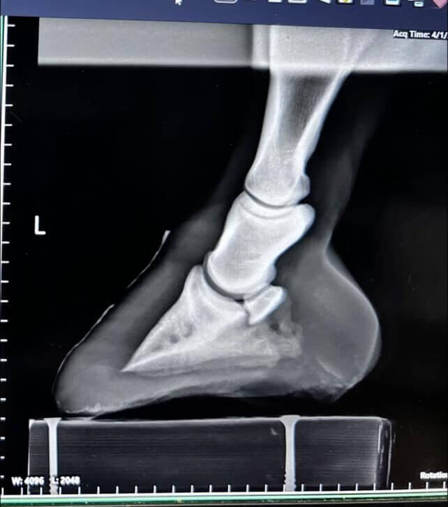 Radiograph after treatment, one year later - coffin bone returned to correct alignment
